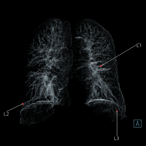 Niskodawkowa tomografia komputerowa płuc. Akademia Tomografii Komputerowej Siemens Healthineers.